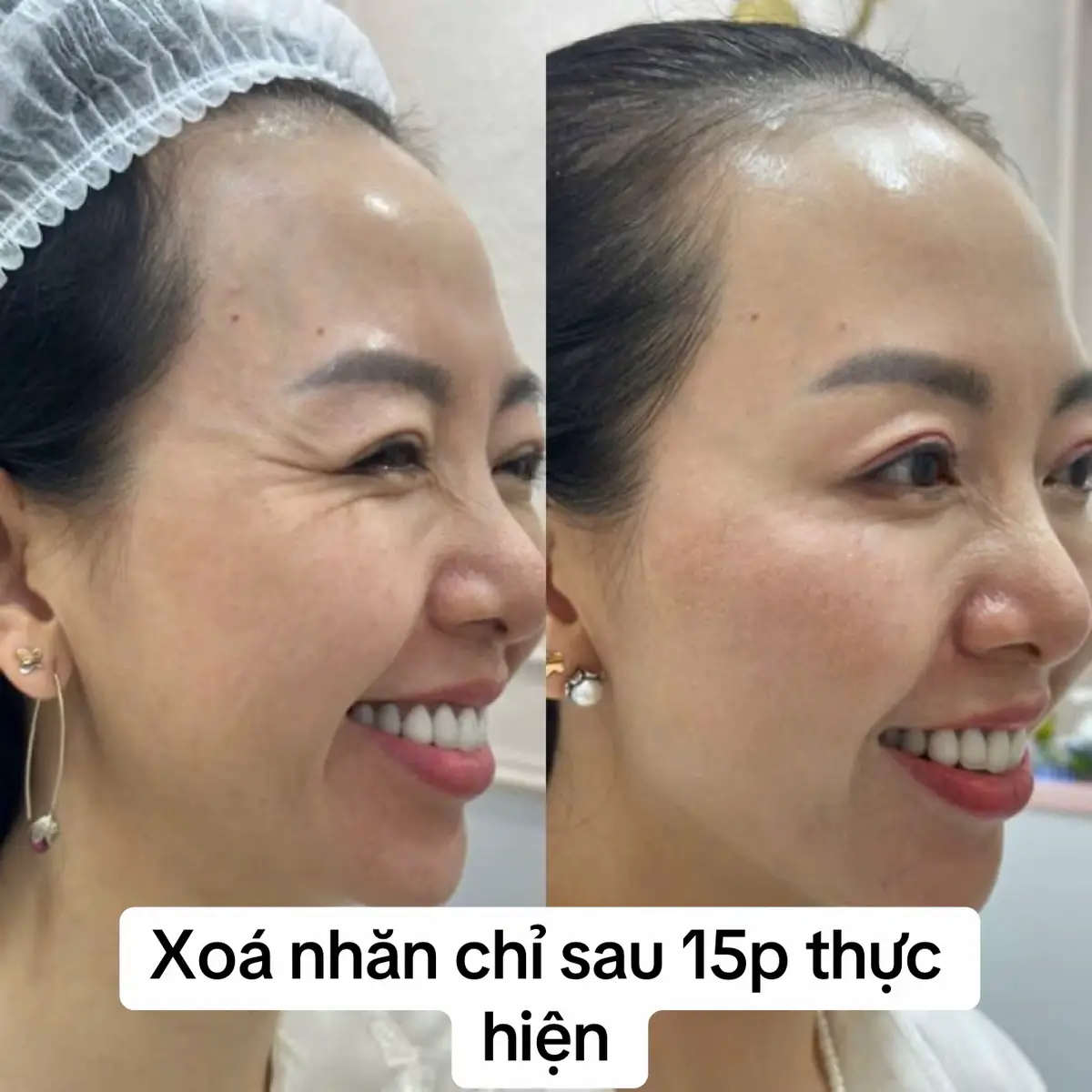 Xoá nhăn chỉ sau 15p thực hiện lấy lại thanh xuân cho các chệ❤️❤️ #fillerbottoxchuanykhoa #thammy #xoanhan #xuhuong 