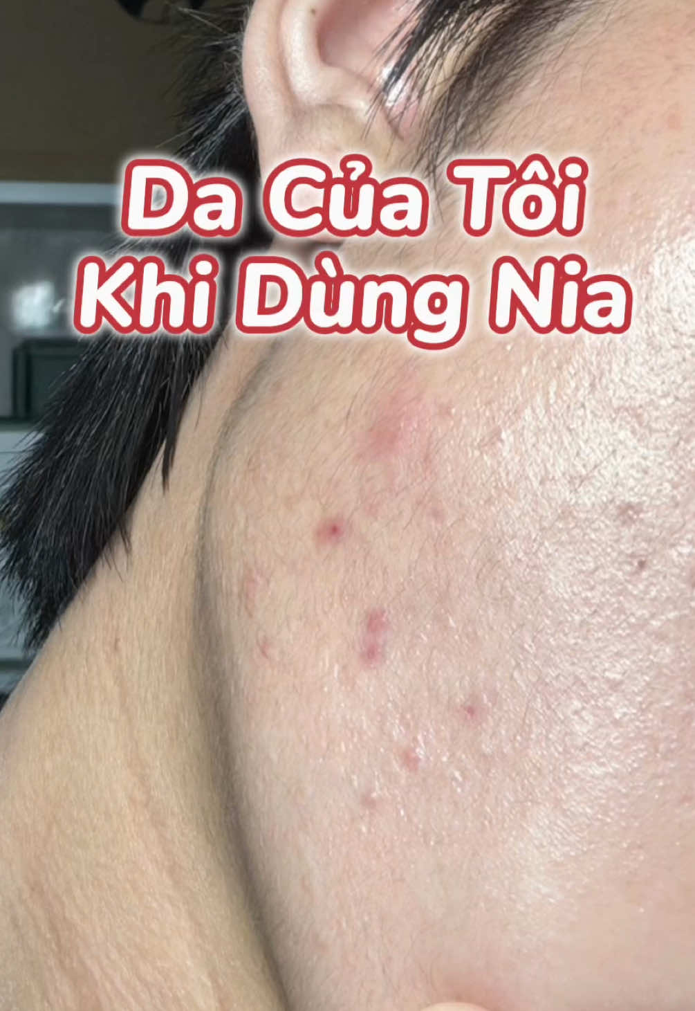 Cho mọi người xem da mình giảm thâm vùng quai hàm gần đây bằng gì nha 🥺🫰🏻    #tinhchatsangdaCarslan  #Carslan7ngaysangda #Carslan #duongsangda #Carslanserumbrightening