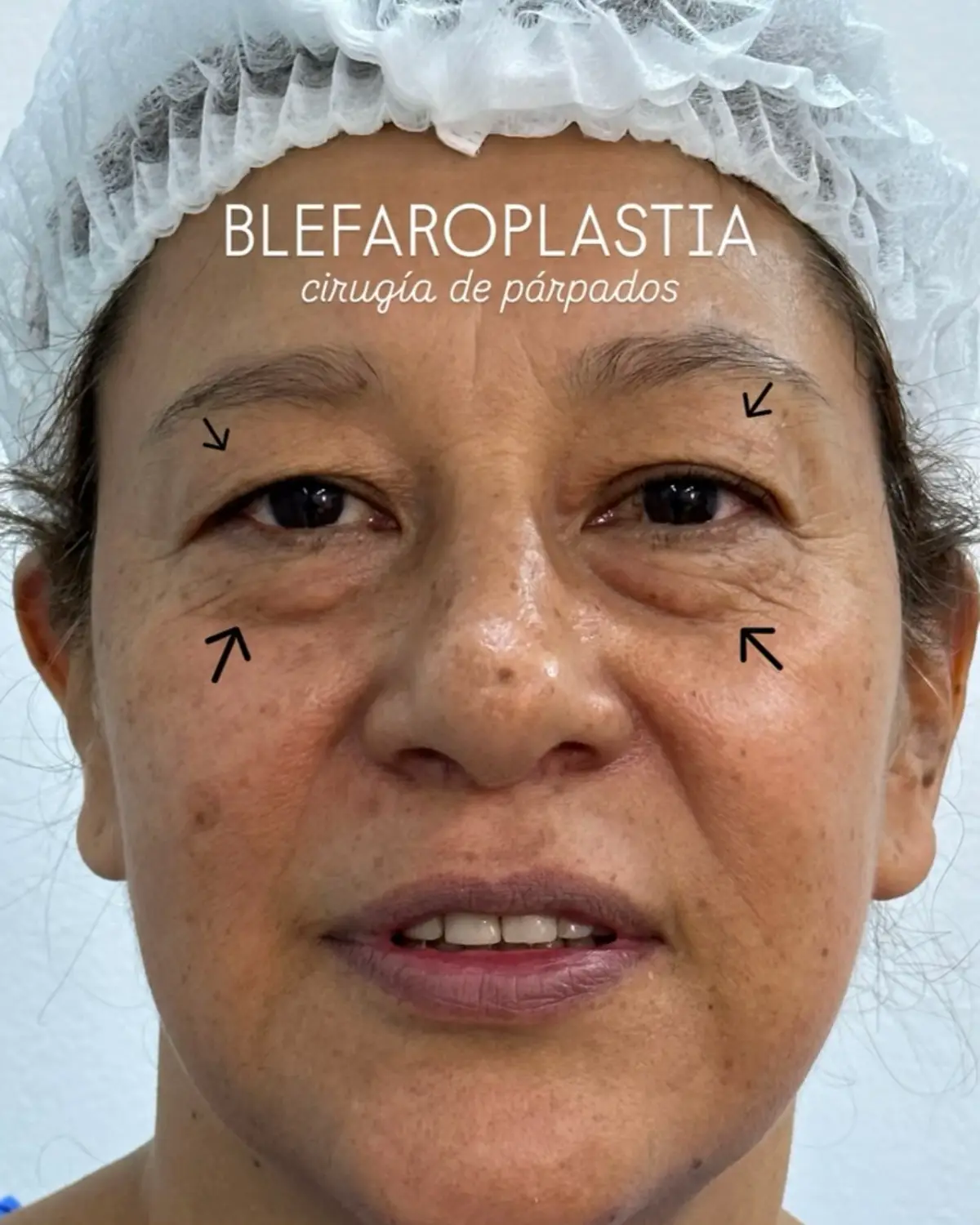 Una mirada renovada, más feliz, más viva 🌸 #blefaroplastia #liftingdecejas #cirugiadeparpados #colombia #fyp 
