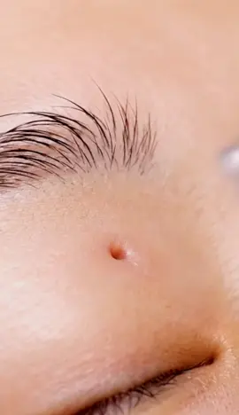 ASMR video #viraltiktok #blackheadremoval #asmrsounds #asmrvideo #tiktokusa🇺🇸 