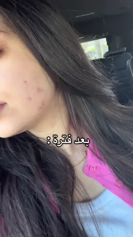 الحبوب الهرمونية رجعت من جديد ( الفديو قبل شهر ونص )  يلا نرجع نكثف عناية بالبشرة  🤍  ونعالج الحبوب بأسرع وقت  #حب_الشباب #حبوب_الوجه #عناية_بالبشرة #البشرة_الدهنية #acne 
