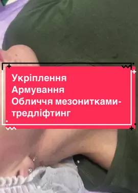 Тредліфтинг — це нехірургічна процедура омолодження шкіри, яка полягає у введенні під шкіру спеціальних біорозсмоктуваних ниток (мезониток) для підтяжки, моделювання та покращення її пружності. Процедура допомагає усунути зморшки, підтягнути обвислі ділянки та створити каркас для шкіри, стимулюючи вироблення власного колагену. #тредліфтинг #косметологбортничі #колаген #колагеностимуляція #контурнапластика 