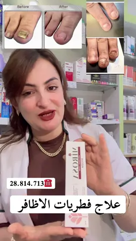 علاج فطريات الاظافر 