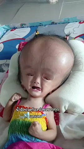 น้องน้ำอิง #เด็กหัวโต #โรคน้ําคั่งในโพรงสมอง 👧🤍