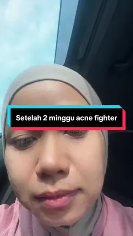 Siapa yg ada masalah stage macam dya boleh sharing apa yg akak buat ?? dan ini apa yg dya pkai           1-makan anti biotik ikut preskiption dc medomycin.                                     2-clindamycin brand tidact.                      3- pencuci muka ada tumic,citrus n tea tree oil 4-moisturiser facerinna yg biru ph 5.5 5.dptkn cahaya pagi sebelum pkul 9am.  6.jangan makan manis dan berminyak. #acnetreatment #acnefighter #ilmubermanfaat 