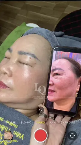 Cập nhật da sạm nám #chamsocdamun#chamsocdaseo#chamsocdanam#tanbinh#Lqspa&academy