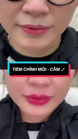 Tiêm chỉnh môi + cằm cho chị khách 💉💖 #TienLeAcademy #botox #tienleacadamy #filler #tiemmoifiller 