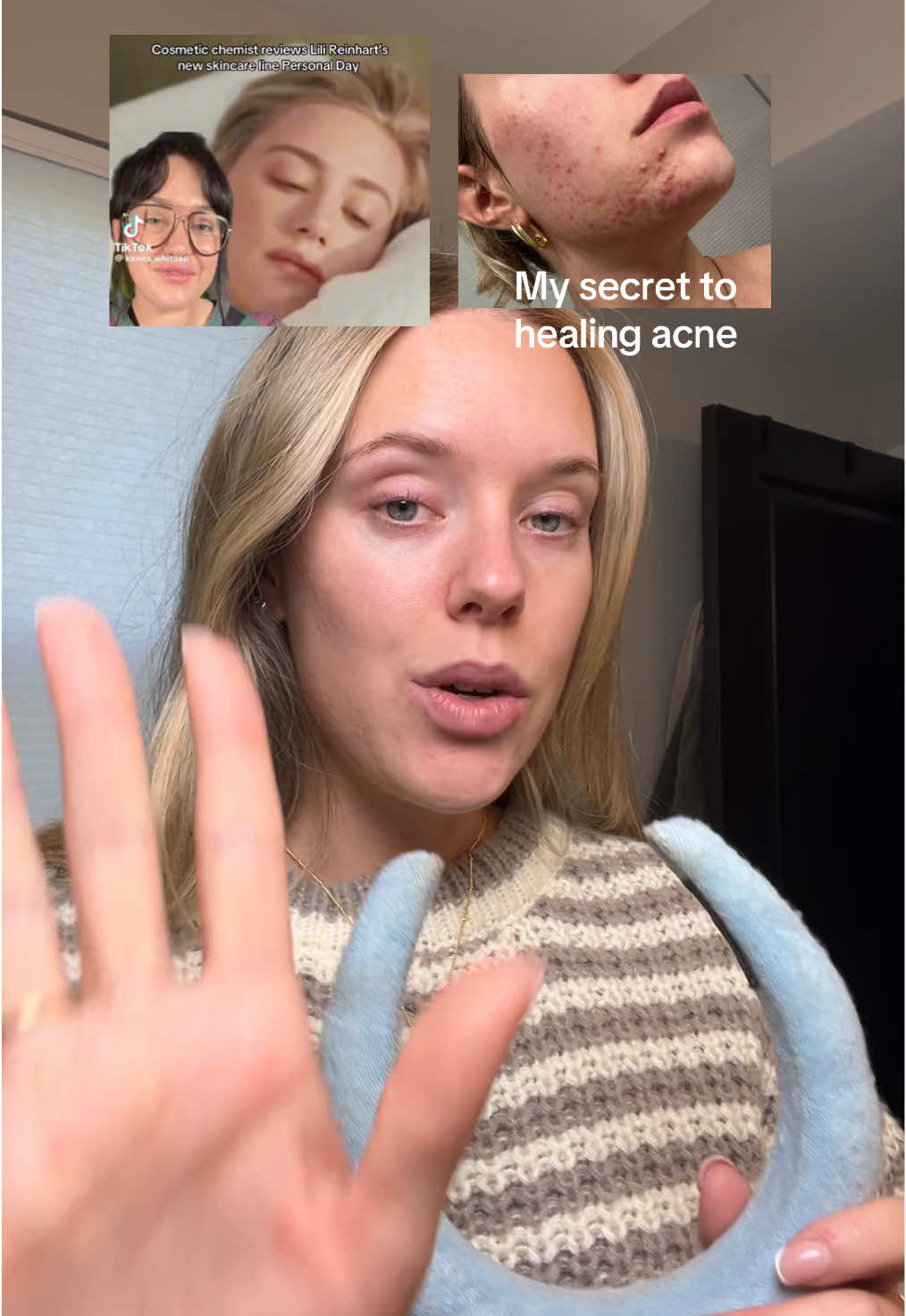 All it took was salicylic acid 🥲 #personalday #salicylicacidproducts #howtotreatacne #acnetreatment #acneskincare 