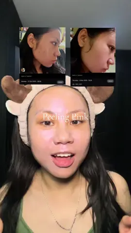 Skincare warna pink dan berglitter pulak tapi ternyata beneran ampuh untuk ilangin darkspot 😭 pantesan aja dia viral di mana” soalnya emang beneran sebagus itu #skincare #skincareroutine #skincaretips #peellikeaproid #worthitsociety 