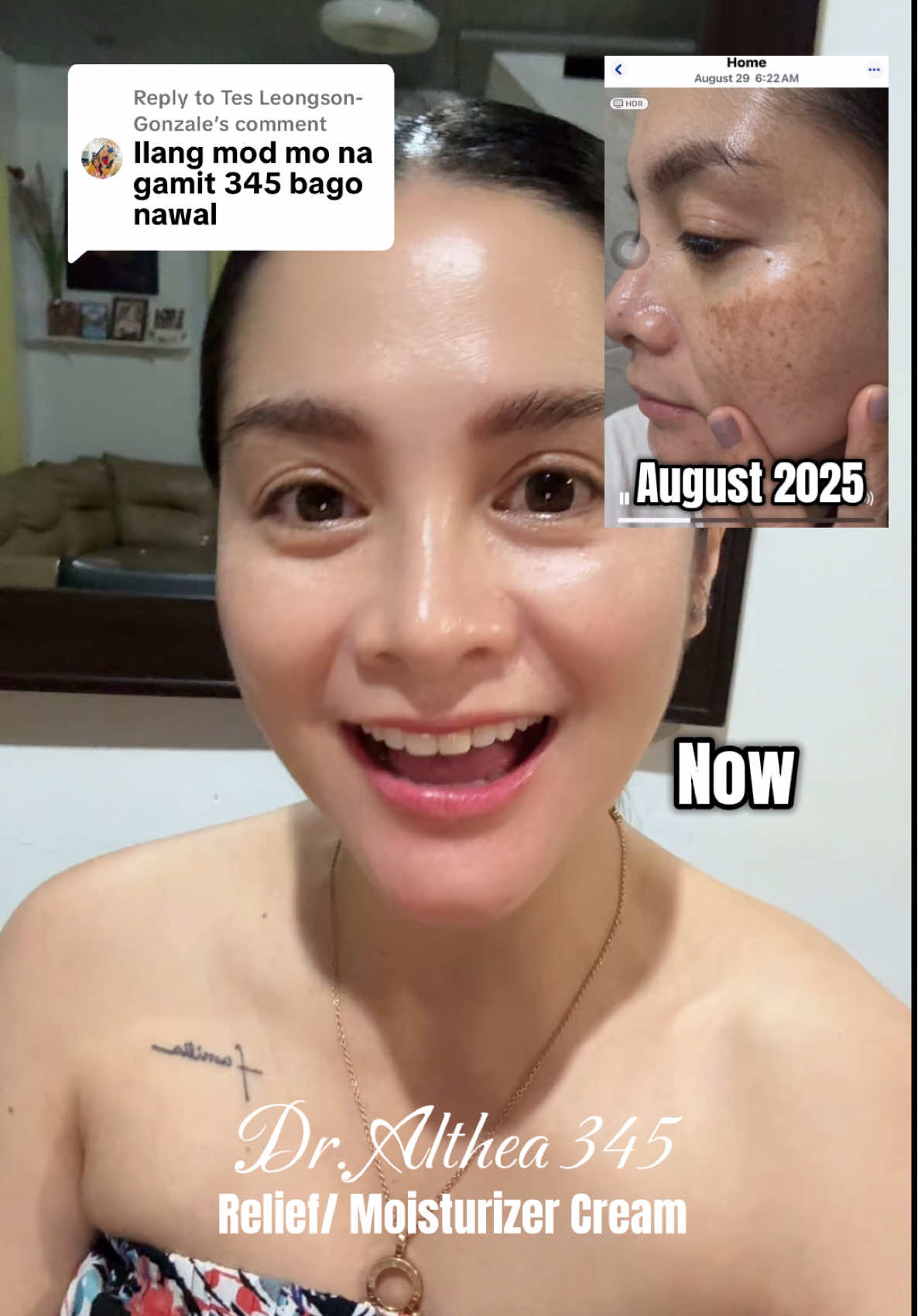 Replying to @Tes Leongson-Gonzale  Mga 3 months po@Nag lighten tlaga melasma ko, thanks Dr. Althea and sa other skincare’s that I used.. I’m so glad I finally found the right creams for my melasma.. #dralthea #dralthea345cream #melasmatreatment #melasmaskincare #melasma 