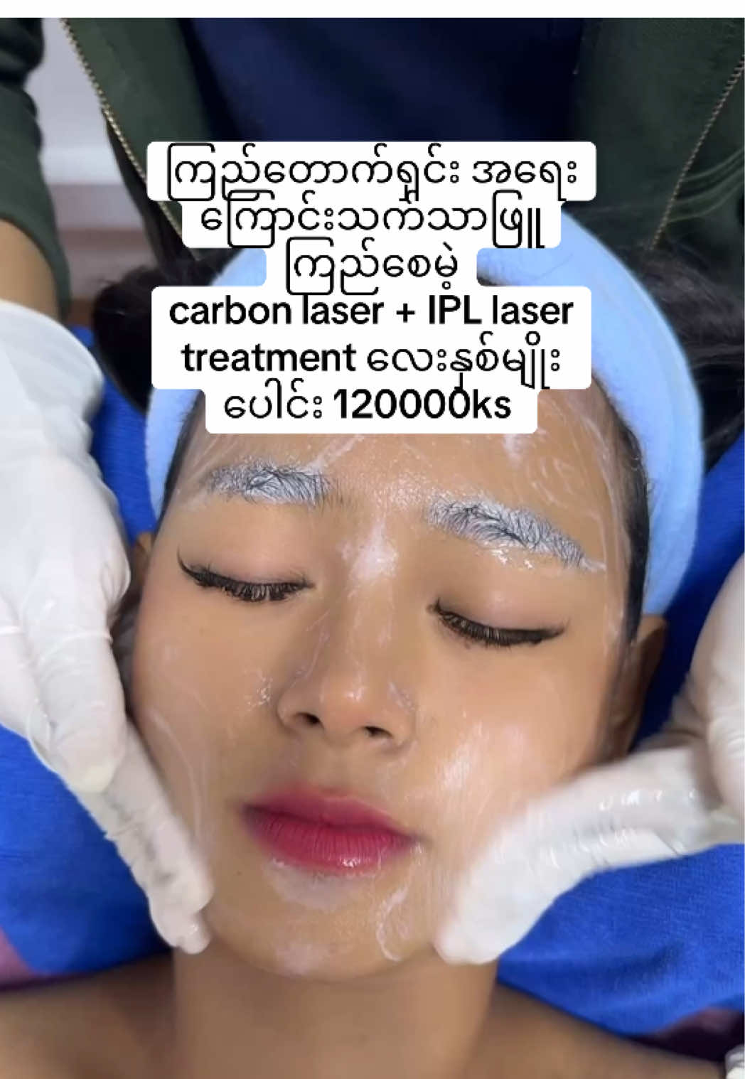 💎 Carbon + IPL တွဲလုပ်သည့် အားသာချက်များ 	1.	အသားအရေသန့်သန့်ရှင်းရှင်း ဖြစ်လာတယ် 	•	Carbon Laser က မျက်နှာပေါ်က ဆဲလ်သေ၊ အဆီချေး၊ အညစ်အကြေးတွေကို သန့်စင်ပေးပြီး 	•	IPL ကတော့ မျက်နှာအပေါ်ယံအရောင် tone ကို ညီညီညာညာဖြစ်အောင် ကူညီပေးတယ်။ → တစ်ပြိုင်နက်တည်းမှာ သန့်ရှင်း+ ညီညာတောက်ပ စေတယ်။ 	2.	Pigmentation (မဲတာ/ညိုတာ/ညစ်တာ) ပိုကောင်းအောင်ကုသတယ် 	•	Carbon က အပေါ်ယံမှေးခြင်းတွေ ဖယ်ပေးတယ်။ 	•	IPL က အမဲစက်/အမာရွတ်pigment တွေကို ပိုမိုဖျော့သွားအောင်လုပ်ပေးတယ်။ → အမာရွတ်၊ နီမြန်းခြင်း၊ နေလောင်ကွက်တွေ လျော့တယ်။ 	3.	Collagen ထုတ်လုပ်မှု ပိုတိုးတယ် 	•	နှစ်စက်လုံးက အသားအရေအတွင်းသို့ အပူသက်ရောက်စေပြီး collagen production တိုးတယ်။ → အသားအရေ တင်းရင်းလာတယ်၊ အရေးအကြောင်းလည်း လျော့တယ်။ 	4.	ဝက်ခြံနဲ့ pores များအတွက် double effect ရတယ် 	•	Carbon က ချွေးပေါက်ကျဉ်းစေပြီးနဲ့ အဆီအညစ်အကြေး/ဆဲလ်သေတွေသန့်စင်ပေးတယ်။ 	•	IPL က ပိုးသတ်ပေးပြီးနဲ့ ဝက်ခြံပြန်မထရအောင် ကာကွယ်ပေးတယ်။ 	5.	အသားအရောင် တောက်ပအောင်ပြောင်းတယ် 	•	Treatment ပြီးချင်းနဲ့ dull skin (မလှတဲ့အသားအရေ) ပျောက်ပြီး healthy glow ပေါ်လာတယ်။ #မြင်ပါများပီးချစ်ကျွမ်းဝင်အောင်လို့🤒🖤 #myanmartiktok🇲🇲🇲🇲 #foryoupage #အမှတ်၂၂ဗိုလ်ရာညွန့်လမ်းအလယ်ဘလောက်ဒဂုံမြို့နယ်သမ္မတရုပ်ရှင်ရုံအနီး09771017646 #laser 