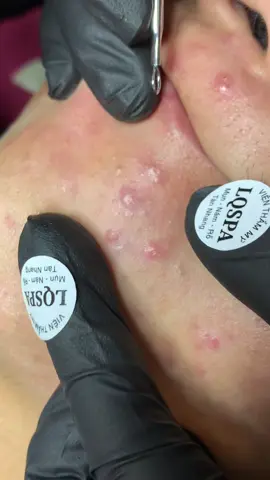 Nè #chamsocdamun#chamsocdaseo#chamsocdanam#tanbinh#Lqspa&academy 