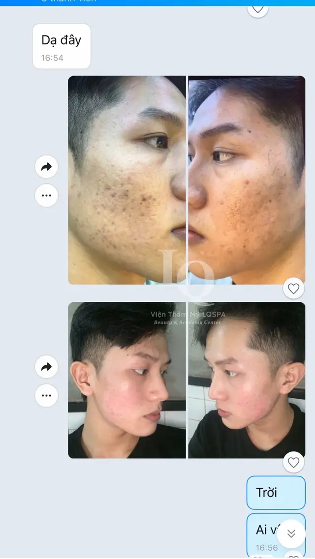 Cập nhật da mụn thâm sẹo #chamsocdamun#chamsocdaseo#chamsocdanam#tanbinh#Lqspa&academy 