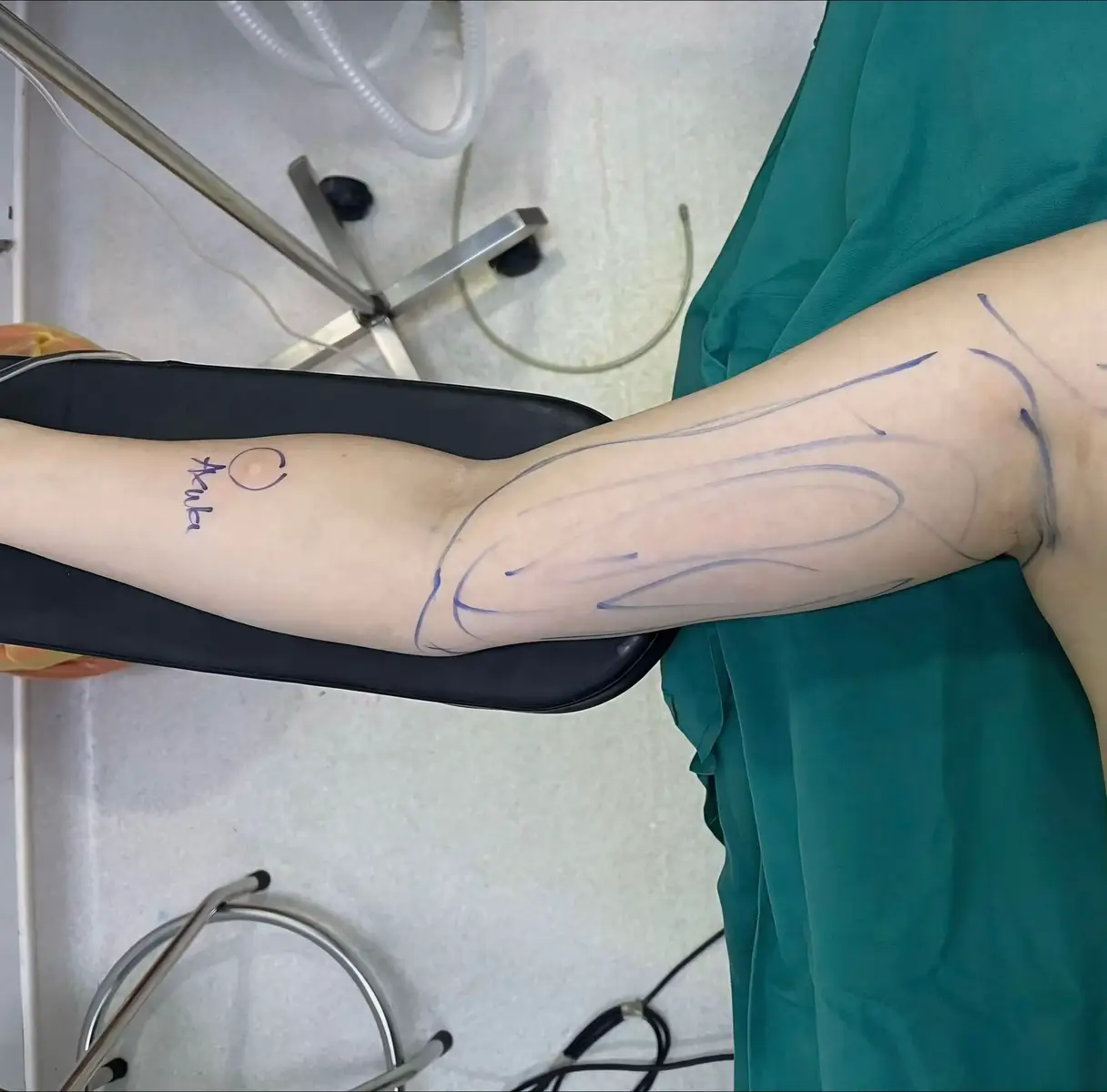 results after 30 minutes of surgery #Dr_lee #liposuction #arm 