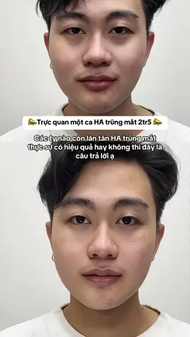 HA trũng mắt thực sự có hiệu quả #dmanh #filler #botox #viral 