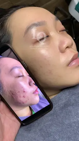 Cập nhật da mụn #chamsocdamun#chamsocdaseo#chamsocdanam#tanbinh#Lqspa 