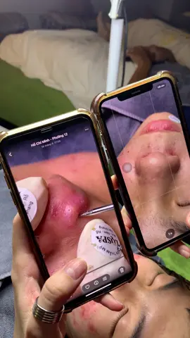 Thực tế da mụn #chamsocdamun#chamsocdaseo#chamsocdanam#tanbinh#Lqspa&academy 