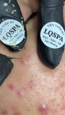 Nha #chamsocdamun#chamsocdaseo#chamsocdanam#tanbinh#Lqspa&academy 