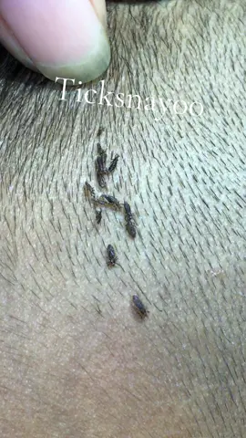Remove lice #😭😭😭 #omg😱😱😱 #lice😰😰😰 #😂😂😂 #tripofobia😮😥 