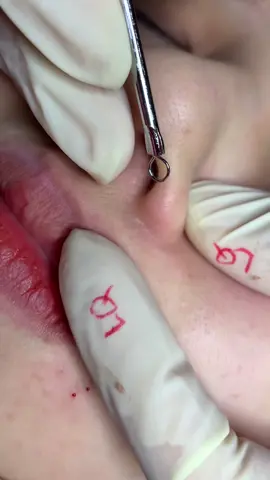 Ngon #chamsocdamun#chamsocdaseo#chamsocdanam#tanbinh#Lqspa&academy 