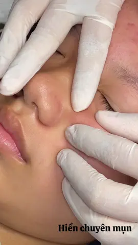 Vùng nhạy cảm 😊#hienchuyenmun #nanmunbangtay #nanmunhoahiep #xoamunruoixuyenmoc #nanmunbungke 