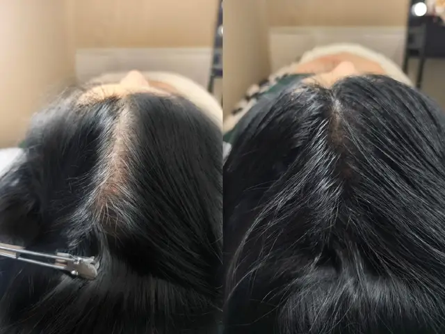 SMP+Hairline just in 1 session!!!!!! Scalp Micro Pigmentation SMP is a non-invasive semi premature aesthetic treatment for hair loss to get fuller look that doesn't damage our scalp.