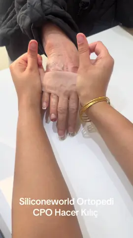 #siliconefinger #parmakprotezi 