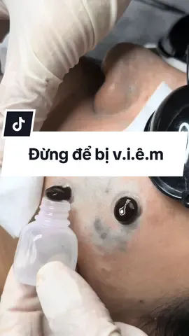 Bạn mà đang có mụn nên đi lấy đừng để b.ị v.iêm nha. #nguyetnanmunbangtay #comungheem #nanmunhcm #nanmungovap #nanmunbangtay 