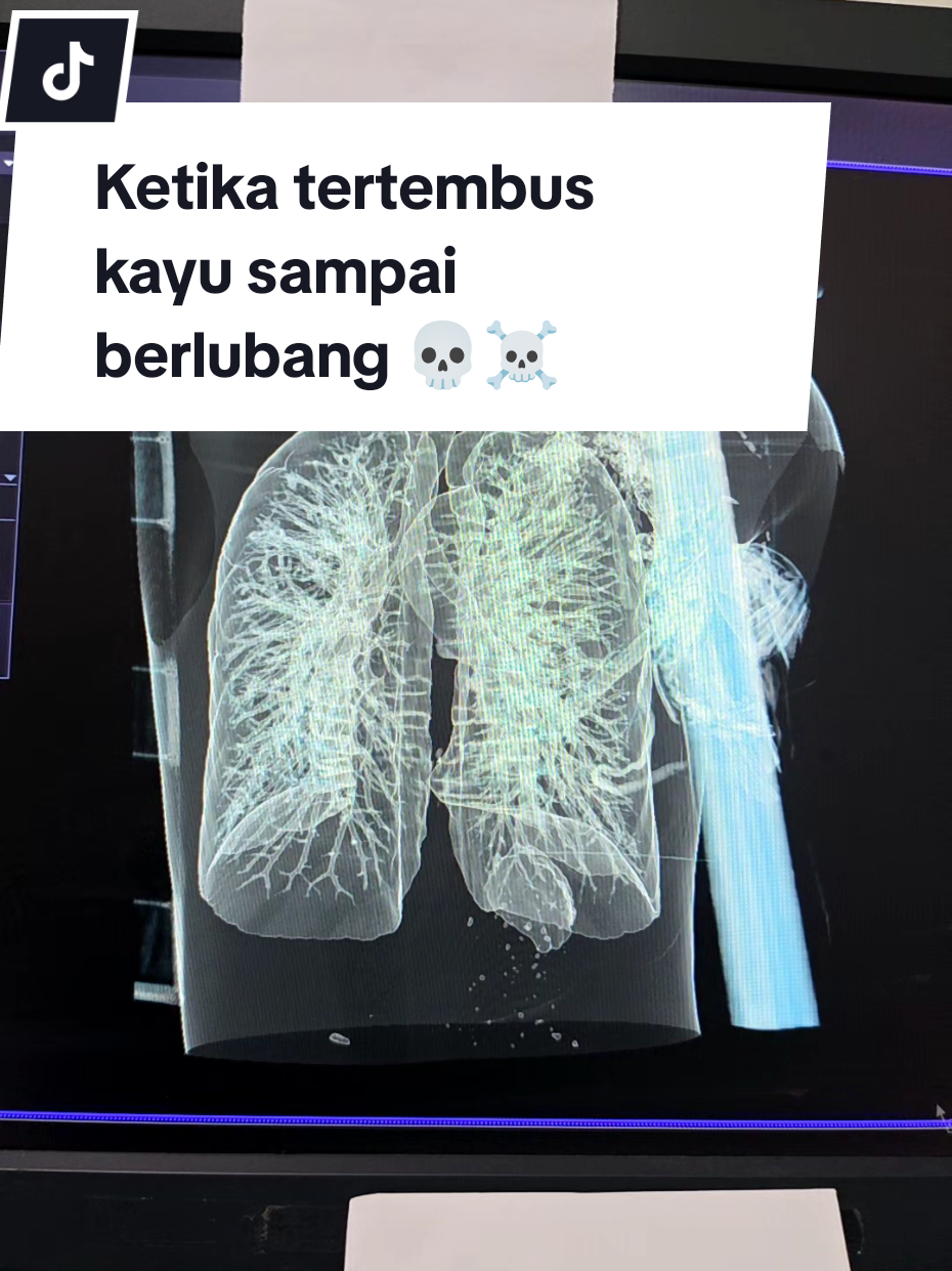 #fyp #trending #viral #kecelakaankerja #corpusalienum  pasien usia 30th kondisi pasien lemas banyak kehilangan darah sedang dalam observasi untuk tindakan operasi . ☠️💀@HanyaFotoTulang @HanyaFotoTulang @HanyaFotoTulang 