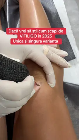 Am întâlnit mulți oameni cu vitiligo într-un timp foarte scurt ,oameni care mulți dintre ei mi au povestit cum au încercat ft multe remedii pt a scăpa de vitiligo ,și în ciuda așteptărilor mele ,ei se aflau la mine în cabinet pentru camuflare. Ceea ce mă face să cred cu toată tăria ,ca metodă Skin Story este singura soluție reală pentru ei. Dacă și tu ai vitiligo te aștept în Constanța ,sau București 21-22 noiembrie sau Londra (29-30 noiembrie )  #vitiligo #camuflarevitiligo #remediivitiligo #bucuresti #londra 