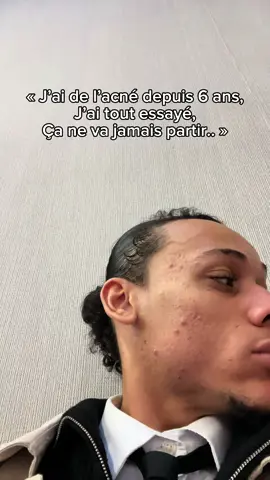 J’ai réussi à éradiquer six ans d’acné le jour où j’ai compris que ce n’était pas un simple problème de peau, mais un problème de santé globale. J’ai commencé à corriger les causes profondes : j’ai arrêté les aliments ultratransformés, régulé mon rythme circadien, repris le soleil, adopté une alimentation riche en produits animaux de qualité, et surtout, je me suis reconnecté à la nature 🌿☀️ Et c’est là que tout a changé : ma peau s’est apaisée, mon énergie est revenue, et mon visage s’est transformé naturellement ✨ 👉 Si toi aussi tu veux transformer ton visage et ton corps en améliorant ta santé et ton énergie, abonne-toi pour plus de vidéos 💪