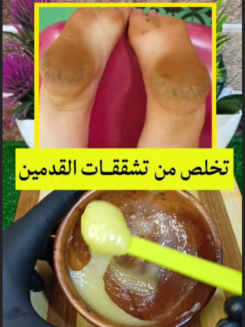 علاج تشقق القدمين #صحتي_بالعربي #صحتي #وصفة #viral #fyp 