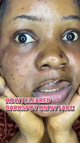 All products are available in store   #darkspottreatment #hyperpigmentation #hyperpigmentationtreatment #foryou 