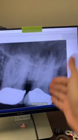 Ten (10) years post-op. Show this to a holistic or biological dentist! #dentists #dentalstudent #rootcanal #dentalhygienist #dentalofficelife 