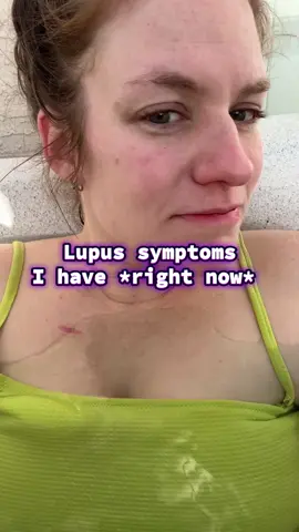 Lupus Symptoms I Have Right Now #lupus #sle #lupuswarrior #lupuswarrior🦋💜 #autoimmunedisease 