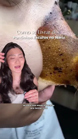 Como se livrar dos filamentos sebáceos 🍓✨ #peleoleosa #sebaceousfilaments #skincare #dicasdebeleza #cuidadoscomapele 