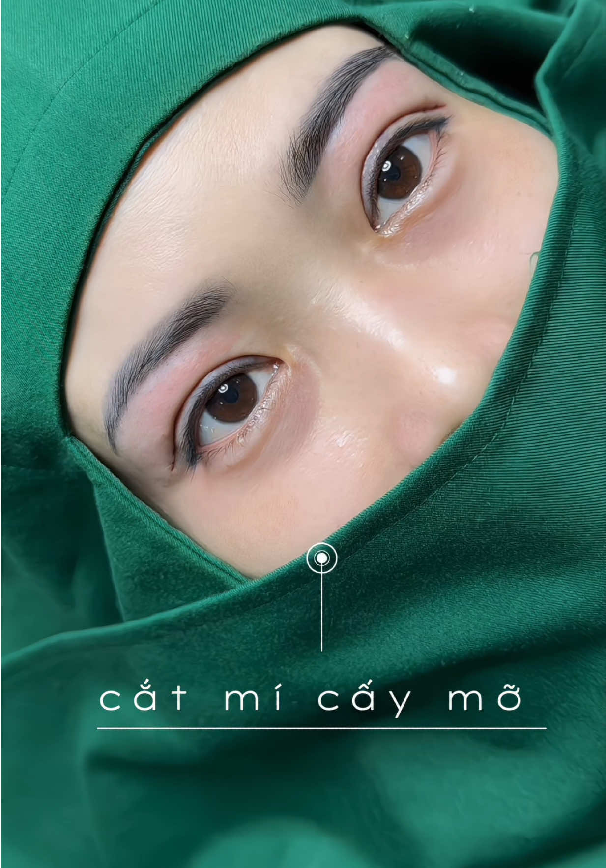 Ai nói cắt mí là giả? Tự nhiên cỡ này ai mà biết được 😝#lamdepantoan #catmi #lamdepuytin 