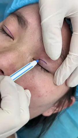 Nhấn mí nhẹ nhàng sau 15p #nhanmi #nhấnmi #nhấnmí #xuhuong #hair 