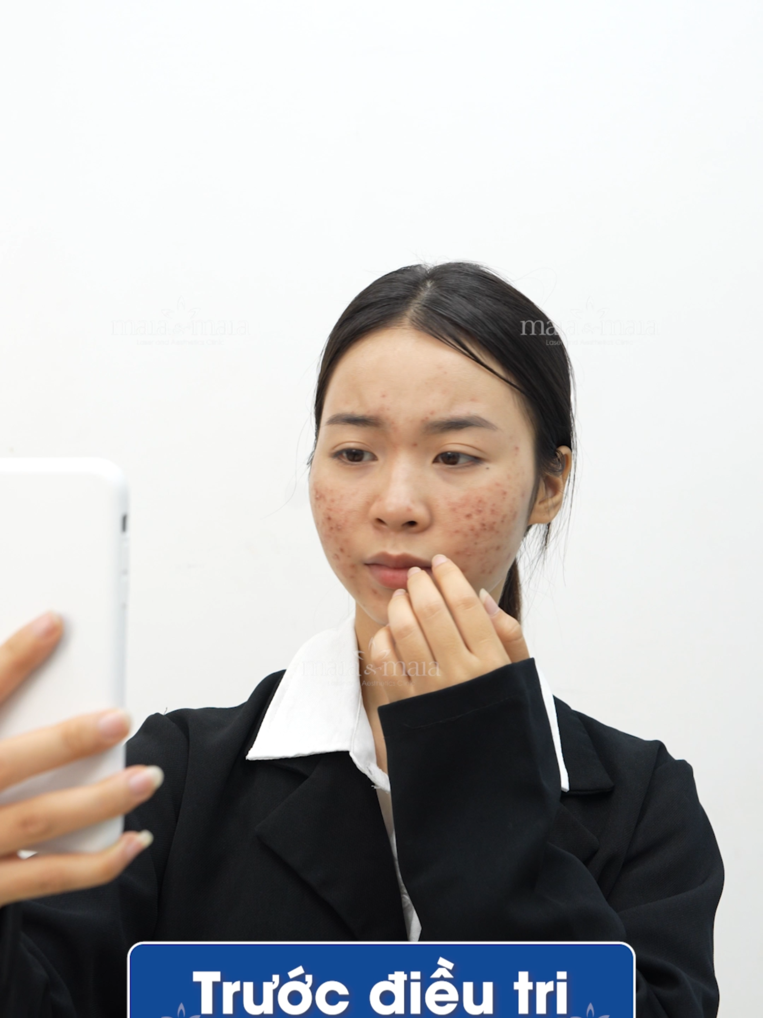 Trị Mụn Chỉ Từ 330k-3 Buổi Sạch 95%. ƯU ĐÃI GIẢM 50% KHI ĐẶT LỊCH TRƯỚC VÀ MIỄN PHÍ SOI DA 100%. Đăng Kí Ngay#fyp #xuhuong #viral #viralvideo #viraltiktok #trendingtiktok #trimun #trimuntham #trimunviem #munan #thammun #seoro #trimunantoan #phongkham #Maia #phongkhammaia