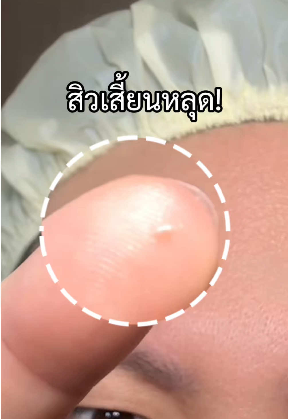 สิวเสี้ยนคือหลุดเป็นตอ! จมูกกลับมาสมูธแบบไม่ต้องงัดออก😂 #สครับยูซุ #Glad2Glow #YuzuCleanser 