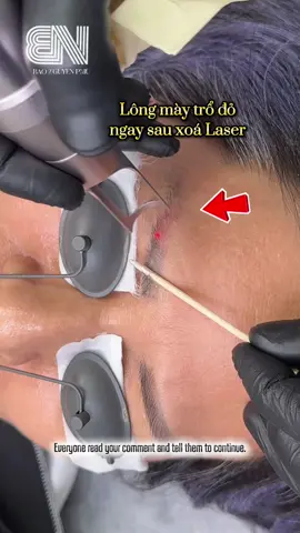 Trả lời @Sa Su bạn tham khảo thử case bày bảo xử lý nha bên Bảo xử lý đỏ nếu đã được lazer bắt màu hết đỏ hẳn chứ khoing phải hết đỏ ảo nha bạn cũng như Bảo có phương pháp hướng dẫn khách hàng phân biệt nên bạn yên tâm nè #baonguyenphunxam  #xoami #xoaxammimat #xoalazer #Eyeliner #phunxamthammy #lamdep #remove #eyebrows #pmu 