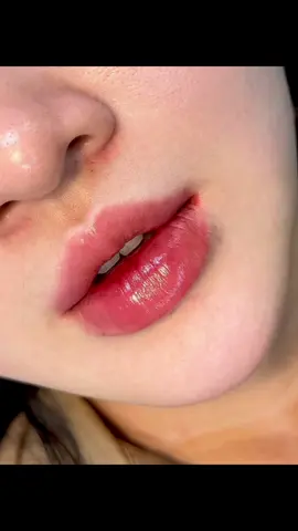 Môi dinh 0.5cc filler CHÂU ÂU