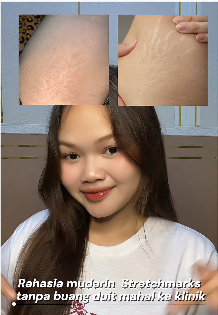 akhirnyaaa gausah buang duit mahal lagi buat ke klinik, ciara pahalawan stretchmark 🥰❣️#stretchmark #stretchmarks #stretchmarkserum #stretchmarkoil #ciaraindonesia 