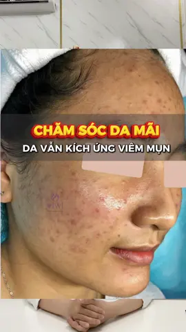 Trị mụn mãi không hiệu quả Thử serum, mask peel nhưng da vẫn viêm mụn chi chít, nhưng đến viwi chỉ sau 1 buổi #viwiclinic #trimun #mụn #muntrungca #munviem