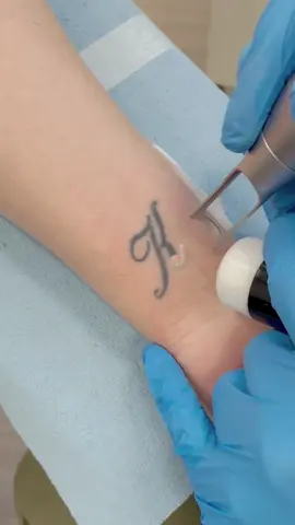 Nearly done with this one - we hit it again after the progress shot, and that should do it #lasertattooremoval #sheffield #leeds #tattooremoval 