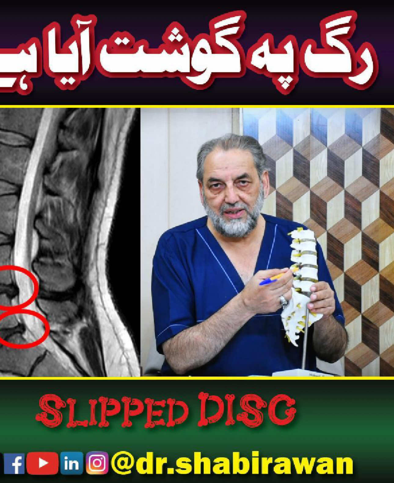 What is sciatica and lambago what if there is bulge on disc in MRI explained very nicely by Dr Shabir Awan FRCS #drshabirawan #goviral #surgery #sciatica #foruyou #backpain #