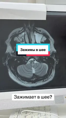 «Зажимы» в шее?