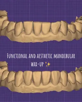 Functional and aesthetic mandibular wax-up ✨ Designed for ideal morphology, balance, and natural harmony between function and form. #exocad #smiledesign #digitaldentistry #fyp #viral 