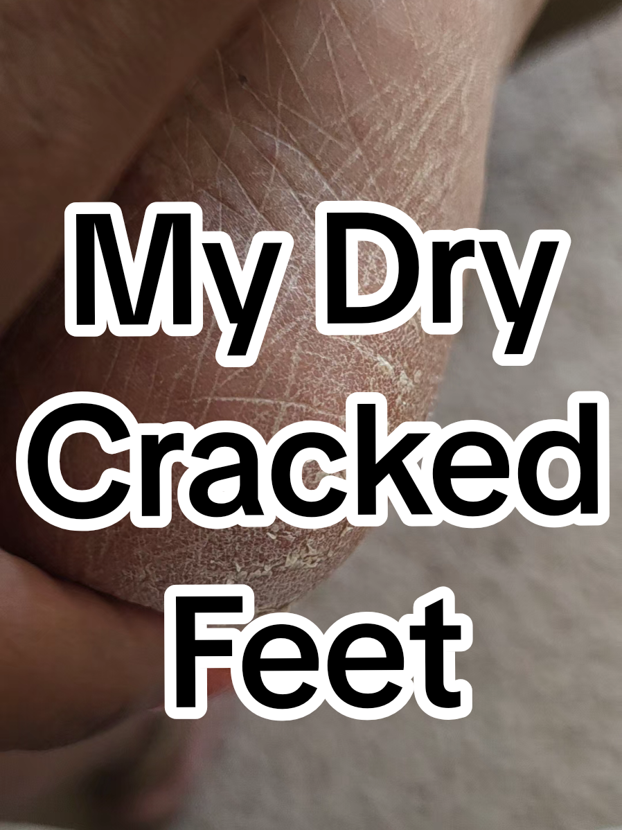 Y'all don't eat me up 😭😭😭 The before and after is so good tho!  I had the exact same issue last year and I'm using the exact same regimen for fast results. Best part for me? I see continuous improvement with each application.  For soft feet fast, go with The Ordinary's Glycolic Acid 7% Exfoliating Toner!  #GlycolicAcid #ExfoliatingToner #tiktokshopblackfriday #tiktokshopcybermonday #tiktokshopcreatorpicks 