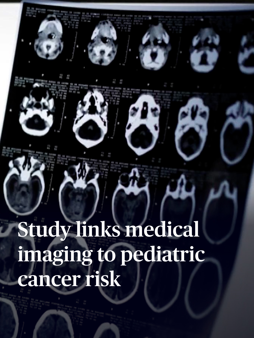 Medical imaging, like X-rays and CT scans, are routine, non-invasive and painless tools used by doctors to make diagnoses. But a recent study of about 4 million children published in the New England Journal of Medicine suggests that the radiation exposure from imaging could pose a risk for pediatric cancer. John Yang speaks with Dr. Rebecca Smith-Bindman, the study’s lead author, to learn more. #pbsnewshour #newshour #pbsnews#xray #ctscan #diagnosis #radiation #pediatriccancer #newengland #journalofmedicine